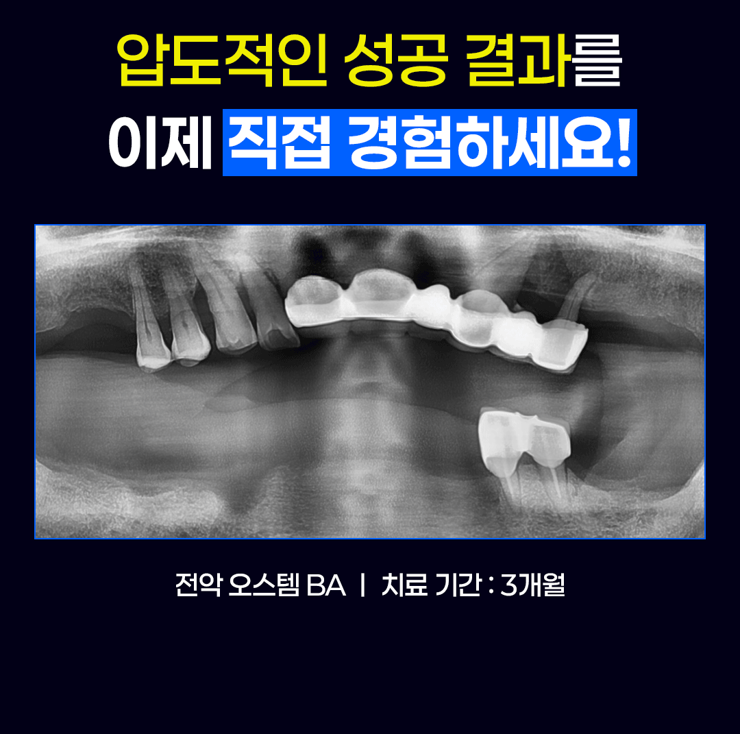 전악 오스템 임플란트 치료 전후, 치료 기간 3개월